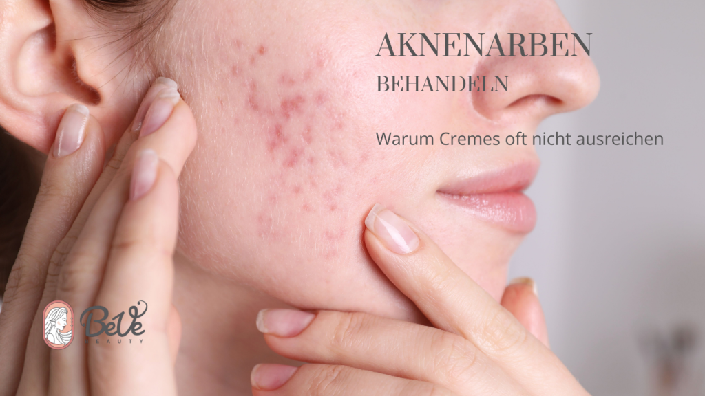 Aknenarben Behandlung Aknenarben Behandlung bei BeVe Beauty in Hanau