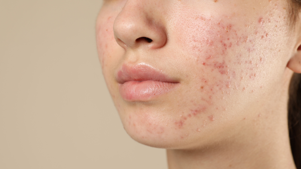 Aknebehandlung bei BeVe Beauty in Hanau