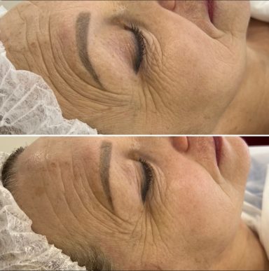 Anti Aging Behandlung