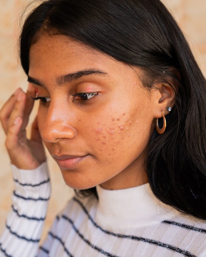 Aknebehandlung in Hanau bei unreiner Haut