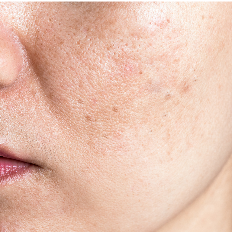 Gesichtsbehandlung, Pigmentflecken und ungleichmäßiger Hautton in Hanau