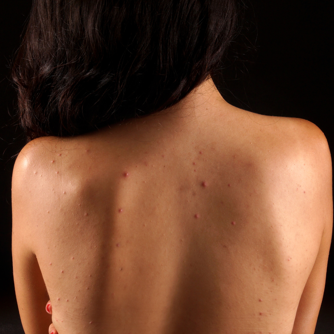 Kosmetische Behandlung unreiner Haut am Rücken bei BeVe Beauty in Hanau