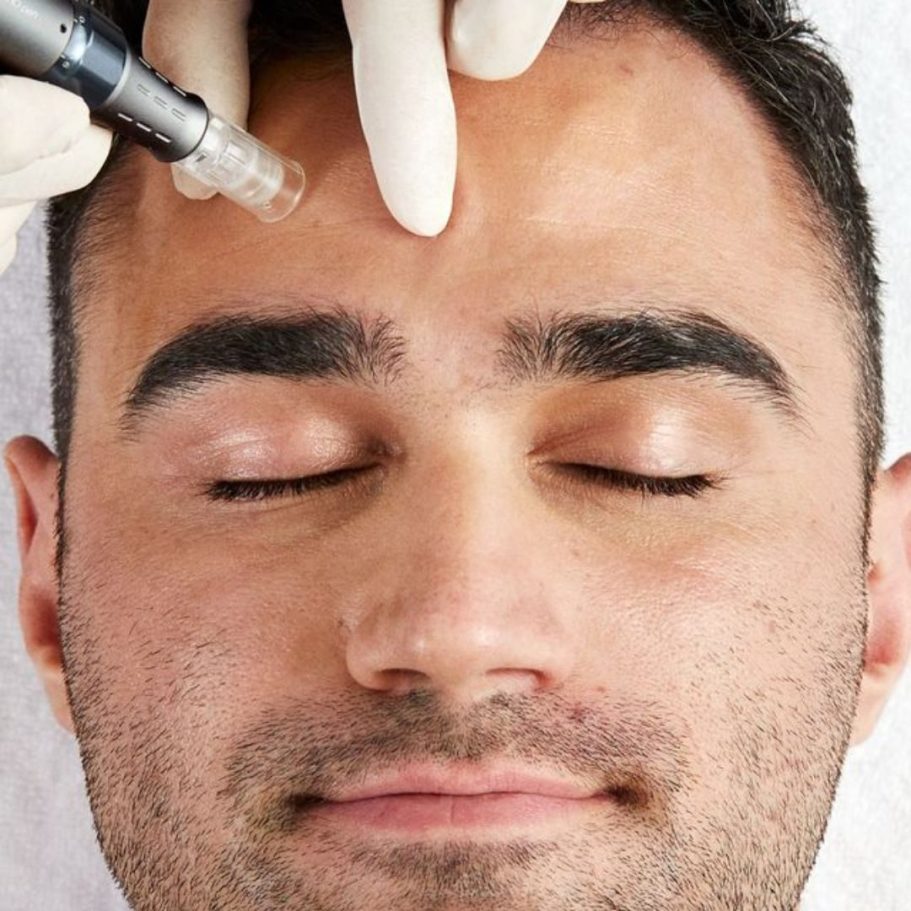 Microneedling Behandlung zur Verbesserung von Hautstruktur und Aknenarben in Hanau