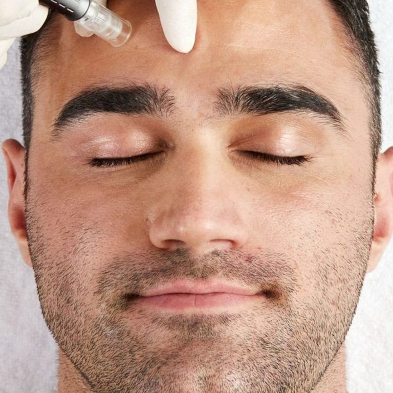 Microneedling-Behandlung in Hanau bei BeVe Beauty regt die Kollagenproduktion der Haut an.