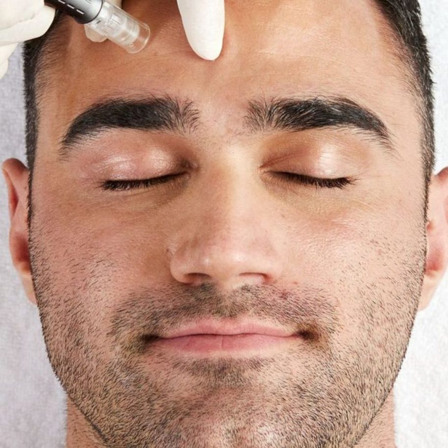 Kosmetisches Microneedling bei Aknenarben und unebener Hautstruktur