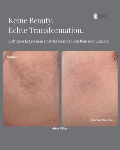 Akne Narben Behandlung bei BeVe Beauty