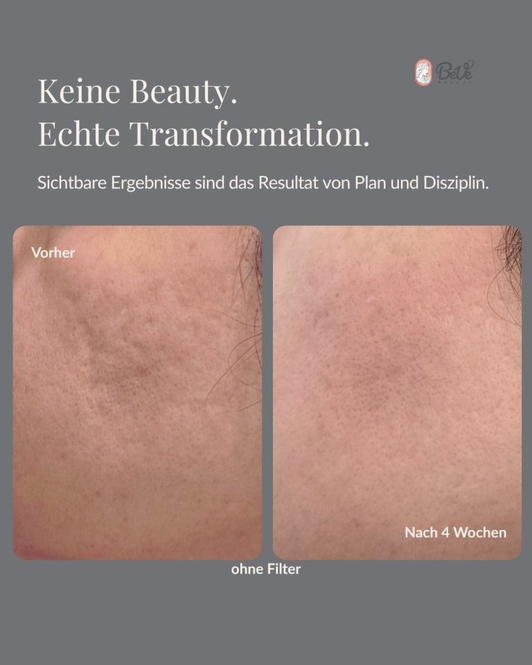 Aknebehandlung in Hanau bei unreiner Haut