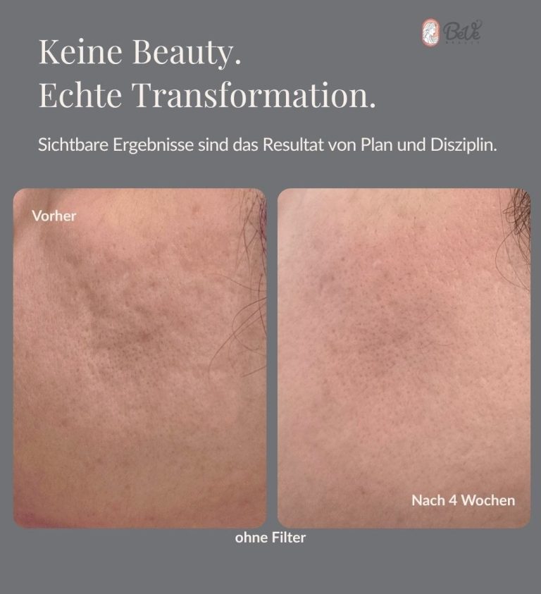 Akne Narben Behandlung in Hanau bei BeVe Beauty