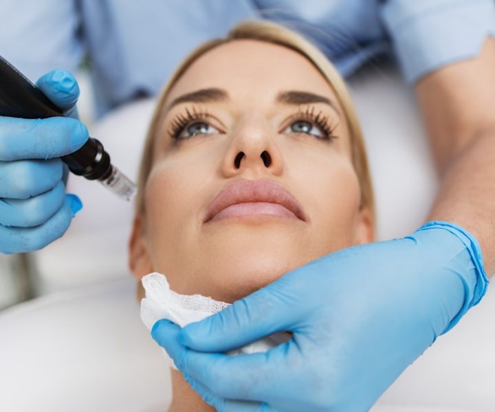 Microneedling in Hanau