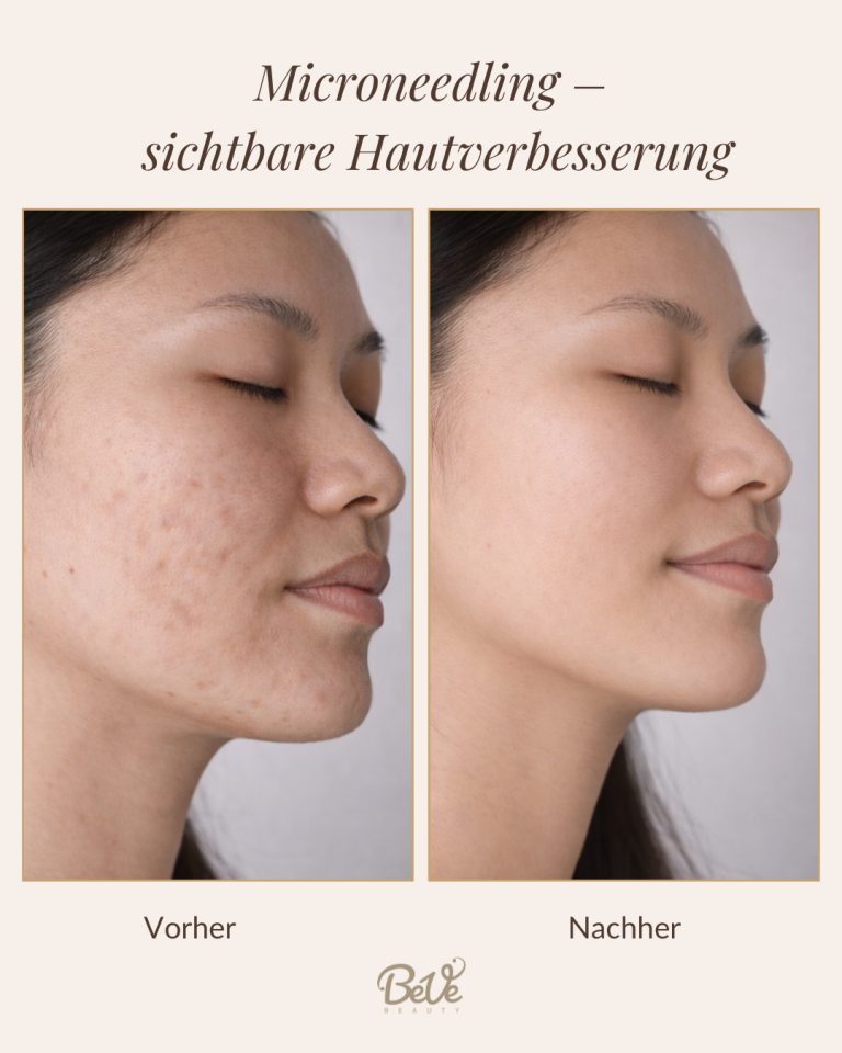 Microneedling Behandlung in Hanau