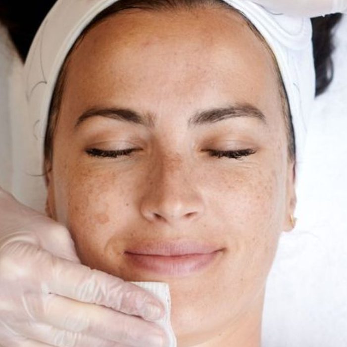 Kosmetisches Peeling bei Verfärbungen und unregelmäßigem Hautbild