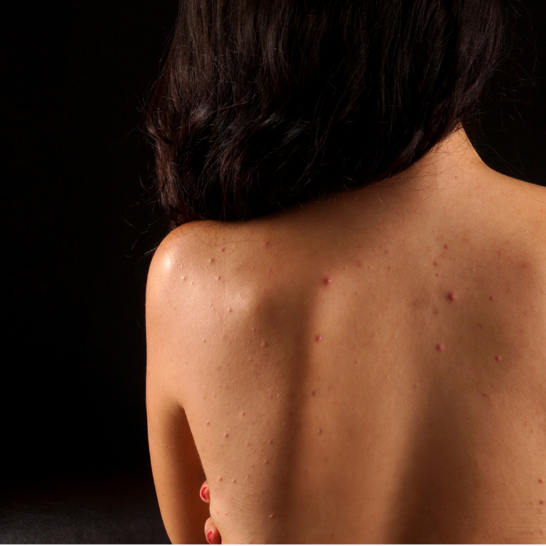 BeVe Back Clear Kosmetische Rückenbehandlung bei BeVe Beauty in Hanau