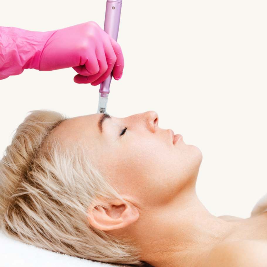 Microneedling Behandlung zur Verbesserung von Hautstruktur und Aknenarben in Hanau