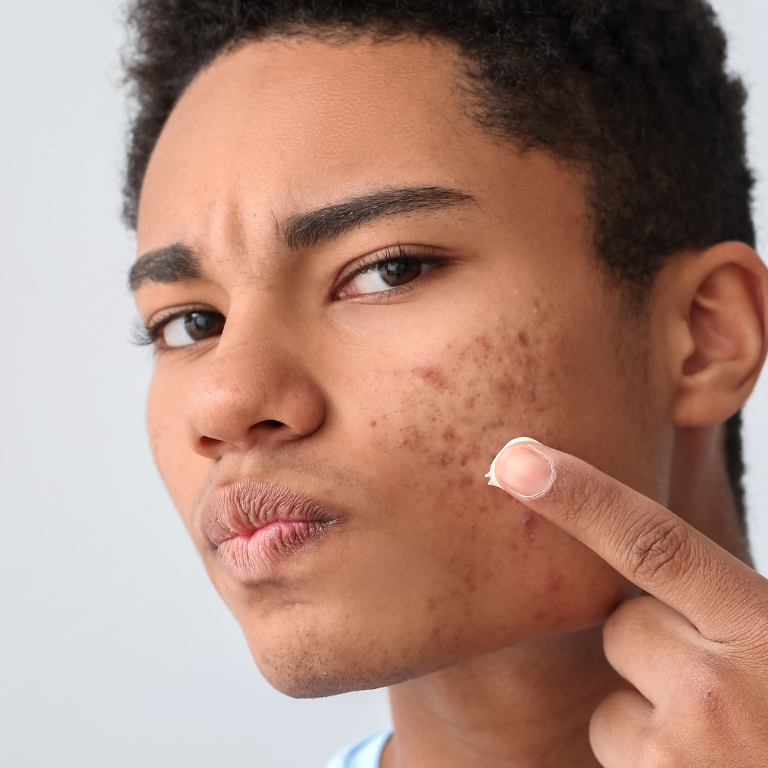 Mann mit sichtbaren Unreinheiten an Wange und Kinn