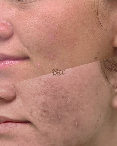 Hautveränderungen vor und nach einer Behandlung, sichtbar am Kinn.