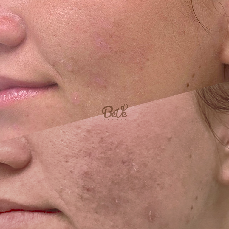 individuell abgestimmte Behandlungen in Hanau bei BeVe Beauty auf deine Haut