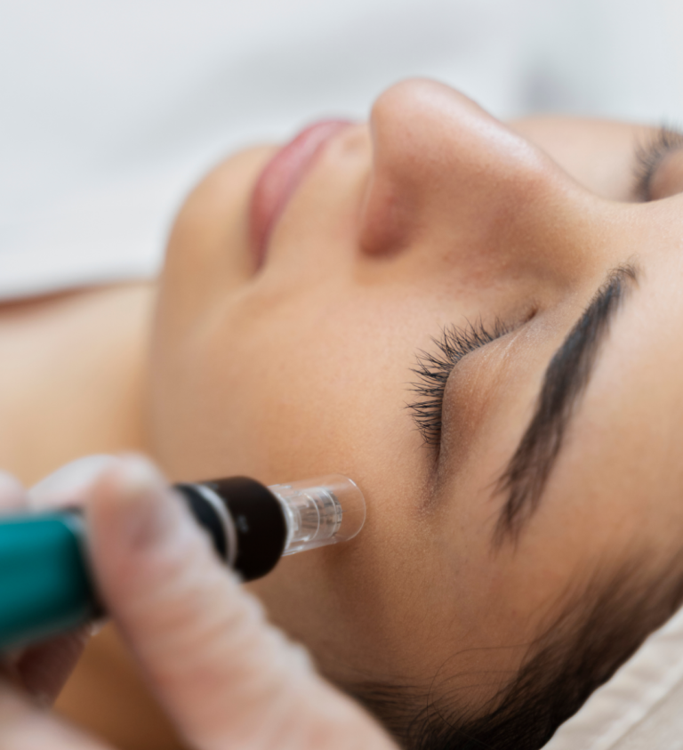 Microneedling Behandlung im Gesicht in Hanau