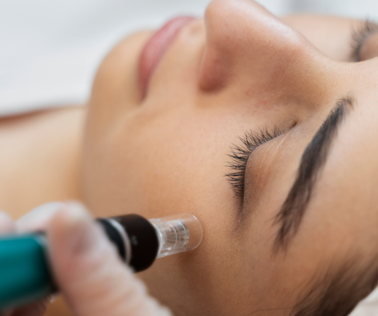 Microneedling Behandlung im Gesicht bei BeVe Beauty in Hanau