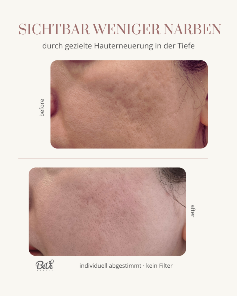 sichtbare Hautverbesserung mit Microneedling in Hanau Microneedling Behandlung in Hanau