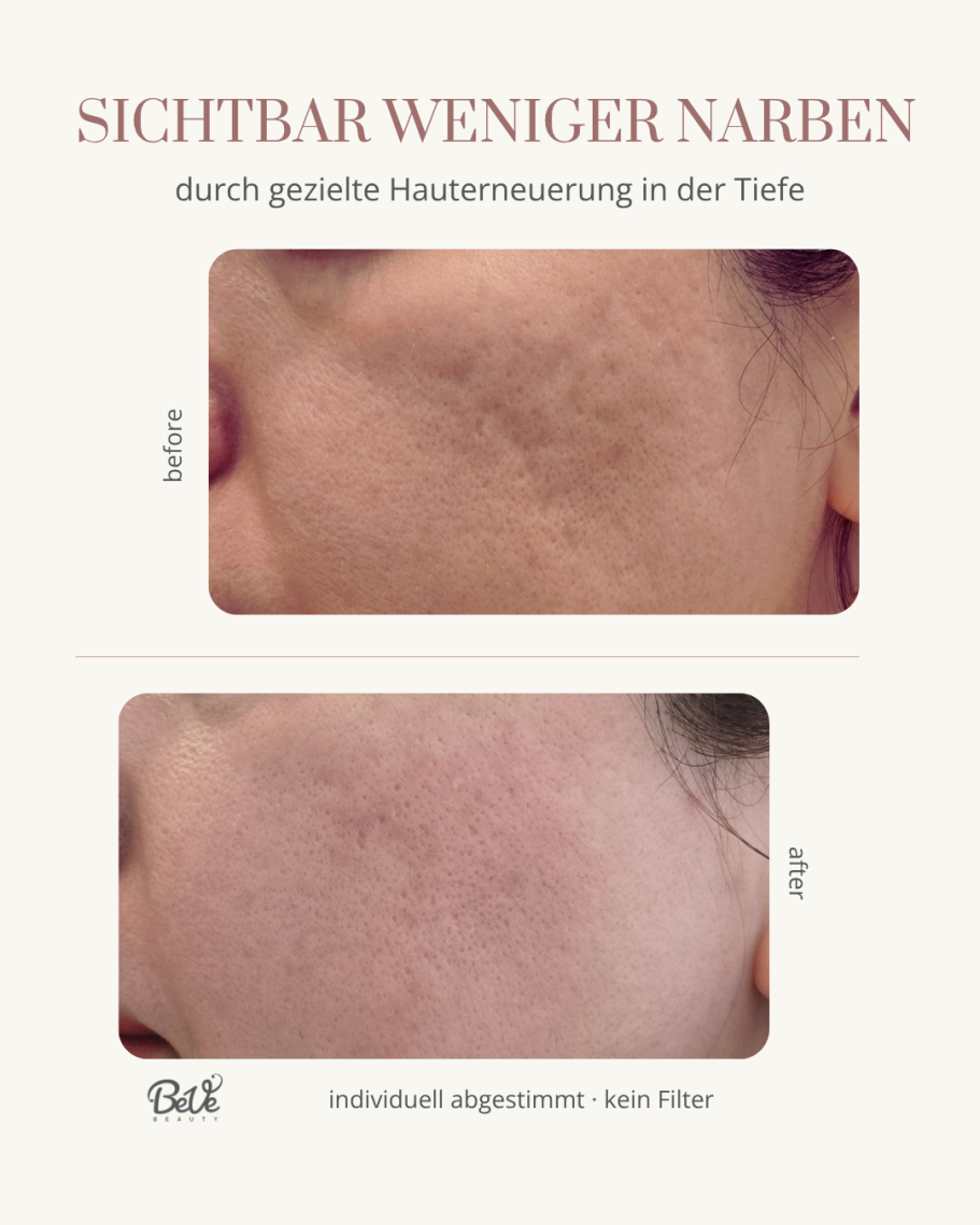 Kombination Microneedling und Exosomen bei BeVe Beauty Hanau
