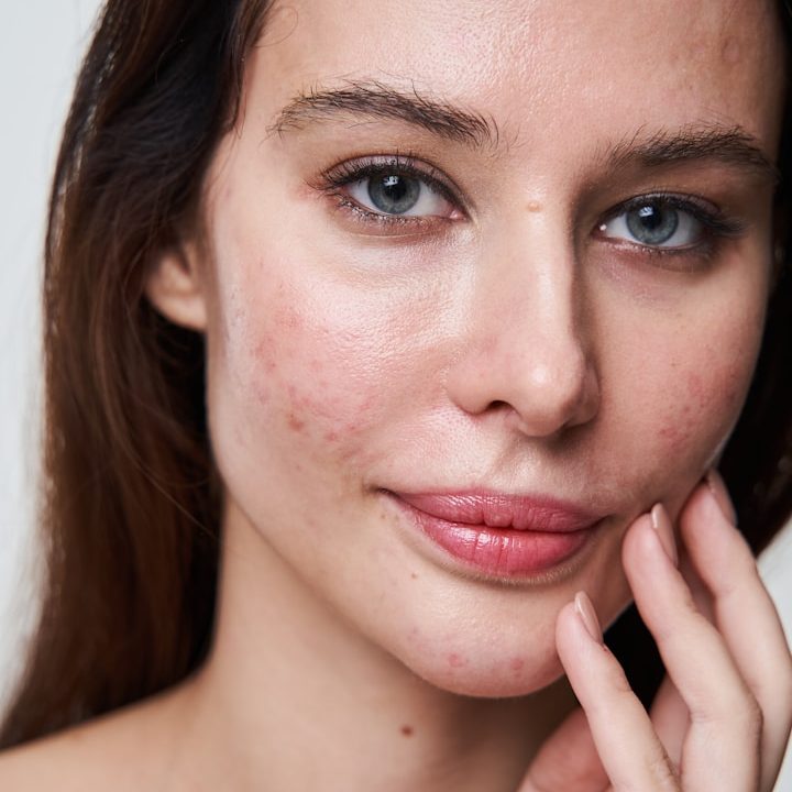 Aknebehandlung bei BeVe Beauty Hanau