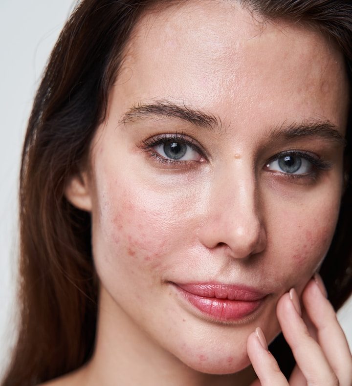 Akne Narben Behandlung in Hanau bei BeVe Beauty