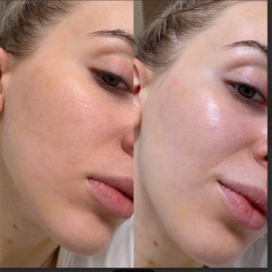 Akne Narben Behandlung