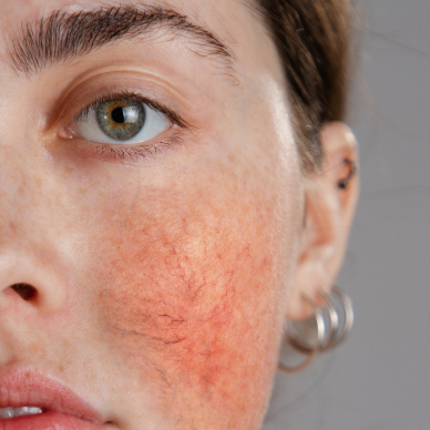 Hautbehandlung  mit Rosazea und empfindliche Haut in Hanau