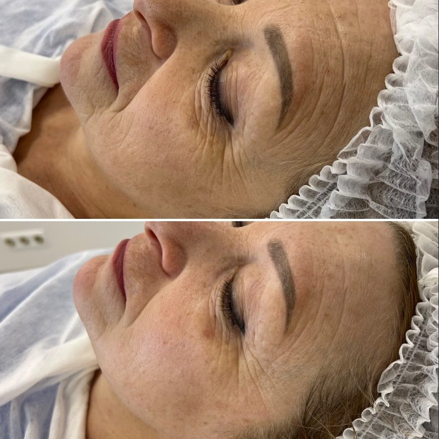 Vorher-Nachher-Vergleich eines Gesichts mit sichtbaren Falten und Veränderungen.