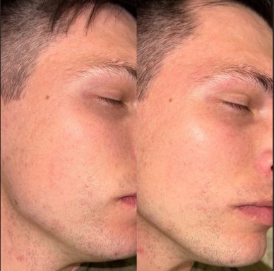 Akne Narben Behandlung